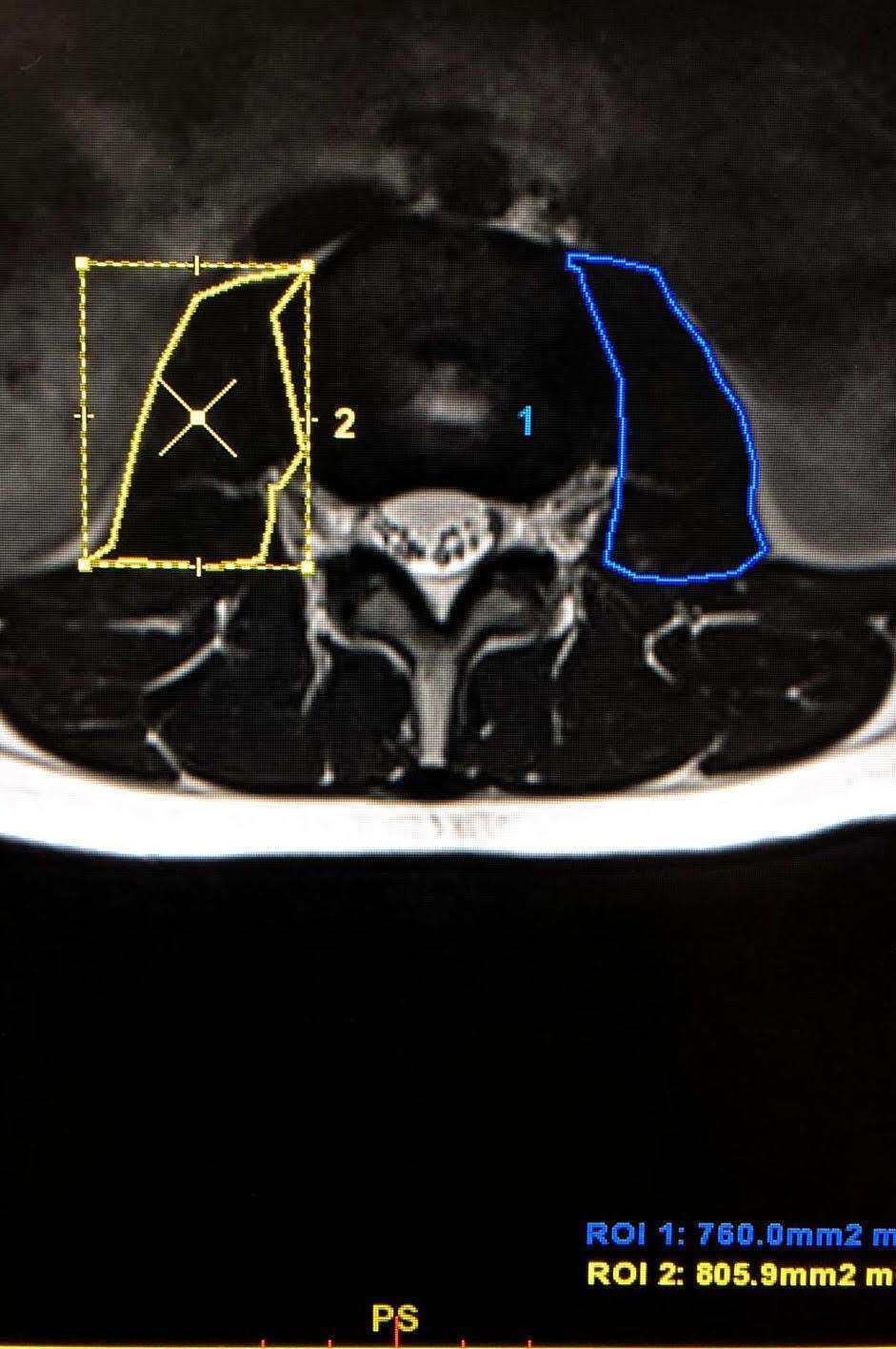 Measurement of the psoas muscle area at the upper endplate of L3 vertebra by ROI